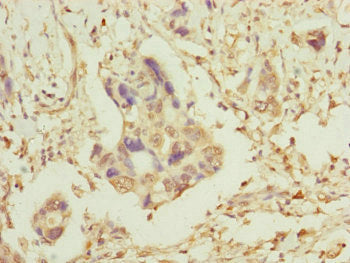 Immunohistochemistry of paraffin-embedded human pancreatic cancer using TOMM34 Antibody at dilution of 1:100Rabbit anti-Human TOMM34 Polyclonal Antibody