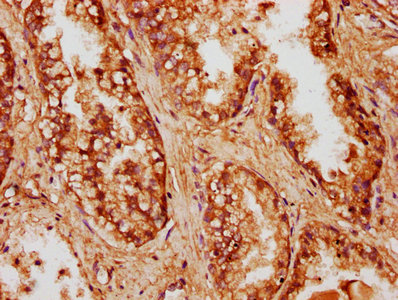 IHC image of CCDC6 Antibody diluted at 1:500 and staining in paraffin-embedded human prostate cancer performed on a Leica BondTM system. After dewaxing and hydration, antigen retrieval was mediated by high pressure in a citrate buffer (pH 6.0). Section was blocked with 10% normal goat serum 30min at RT. Then primary antibody (1% BSA) was incubated at 4°C overnight. The primary is detected by a biotinylated secondary antibody and visualized using an HRP conjugated SP system.