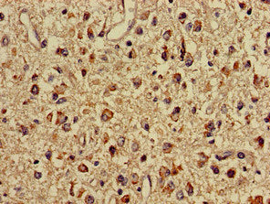 Immunohistochemistry of paraffin-embedded human glioma using IMMT Antibody at dilution of 1:100Rabbit anti-Human IMMT Polyclonal Antibody