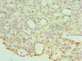 Immunohistochemistry of paraffin-embedded human endommetrial cancer using HYAL1 Antibody at dilution of 1:100
