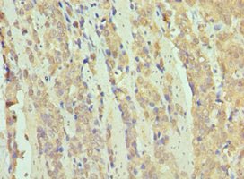 Immunohistochemistry of paraffin-embedded human colon cancer using SMARCB1 Antibody at dilution of 1:100Rabbit anti-Human SMARCB1 Polyclonal Antibody