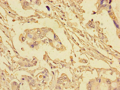 Immunohistochemistry of paraffin-embedded human pancreatic cancer using the antibody at dilution of 1:100Rabbit anti-Human EIF4EBP1 Polyclonal Antibody