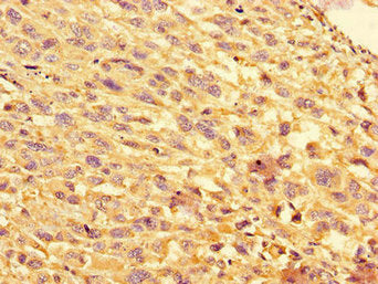 Immunohistochemistry of paraffin-embedded human melanoma using EIF4EBP1 Antibody at dilution of 1:100Rabbit anti-Human EIF4EBP1 Polyclonal Antibody