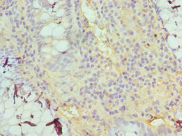 Immunohistochemistry of paraffin-embedded human colon cancer using TDG Antibody at dilution of 1:100Rabbit anti-Human TDG Polyclonal Antibody