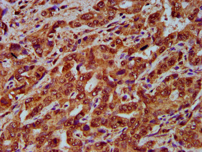 IHC image of CNGB1 Antibody diluted at 1:200 and staining in paraffin-embedded human liver cancer performed on a Leica BondTM system. After dewaxing and hydration, antigen retrieval was mediated by high pressure in a citrate buffer (pH 6.0). Section was blocked with 10% normal goat serum 30min at RT. Then primary antibody (1% BSA) was incubated at 4°C overnight. The primary is detected by a biotinylated secondary antibody and visualized using an HRP conjugated SP system.Rabbit anti-Human CNGB1 Polyclonal Antibody