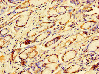 Immunohistochemistry of paraffin-embedded human gastric cancer using TFDP2 Antibody at dilution of 1:100Rabbit anti-Human TFDP2 Polyclonal Antibody