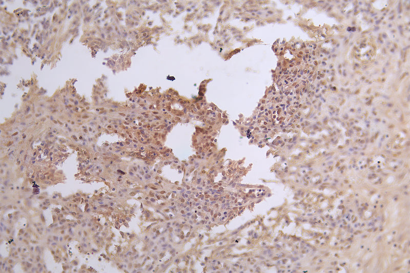 IHC image of E2F2 Antibody diluted at 1:100 and staining in paraffin-embedded human Neuroma tissue performed on a Leica BondTM system. After dewaxing and hydration, antigen retrieval was mediated by high pressure in a citrate buffer (pH 6.0). Section was blocked with 10% normal goat serum 30min at RT. Then primary antibody (1% BSA) was incubated at 4°C overnight. The primary is detected by a Goat anti-rabbit polymer IgG labeled by HRP and visualized using 0.05% DAB.Rabbit anti-Human E2F2 Polyclonal Antibody