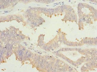 Immunohistochemistry of paraffin-embedded human prostate cancer using EIF2B1 Antibody at dilution of 1:100Rabbit anti-Human EIF2B1 Polyclonal Antibody