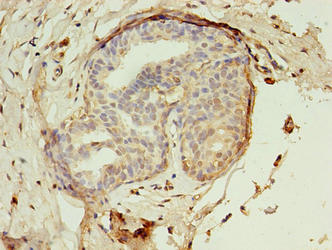 Immunohistochemistry of paraffin-embedded human breast cancer using EBP Antibody at dilution of 1:100Rabbit anti-Human EBP Polyclonal Antibody