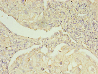 Immunohistochemistry of paraffin-embedded human lung cancer using EBP Antibody at dilution of 1:100Rabbit anti-Human EBP Polyclonal Antibody