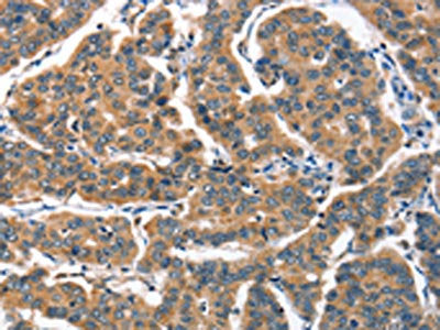 The image on the left is immunohistochemistry of paraffin-embedded Human breast cancer tissue using ALOX15 Antibody(ALOX15 Antibody) at dilution 1/60, on the right is treated with synthetic peptide. (Original magnification: ×200)Rabbit anti-Human ALOX15 Polyclonal Antibody