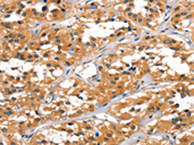 The image on the left is immunohistochemistry of paraffin-embedded Human thyroid cancer tissue using the antibody Antibody) at dilution 1/60, on the right is treated with synthetic peptide. (Original magnification: ×200)Rabbit anti-Human ALOX15 Polyclonal Antibody