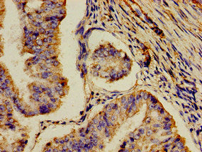 Immunohistochemistry of paraffin-embedded human endometrial cancer using the antibody at dilution of 1:100Rabbit anti-Human AOC3 Polyclonal Antibody