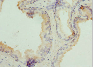 Immunohistochemistry of paraffin-embedded human prostate cancer using TPD52L1 Antibody at dilution of 1:100Rabbit anti-Human TPD52L1 Polyclonal Antibody
