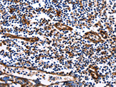 The image on the left is immunohistochemistry of paraffin-embedded Human tonsil tissue using DUSP6 Antibody(DUSP6 Antibody) at dilution 1/25, on the right is treated with fusion protein. (Original magnification: ×200)Rabbit anti-Human DUSP6 Polyclonal Antibody