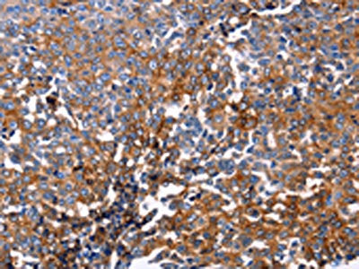 The image on the left is immunohistochemistry of paraffin-embedded Human ovarian cancer tissue using the antibody Antibody) at dilution 1/25, on the right is treated with fusion protein. (Original magnification: ×200)Rabbit anti-Human DUSP6 Polyclonal Antibody