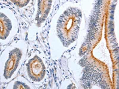 The image on the left is immunohistochemistry of paraffin-embedded Human colon cancer tissue using PLAUR Antibody(PLAUR Antibody) at dilution 1/50, on the right is treated with fusion protein. (Original magnification: ×200)Rabbit anti-Human PLAUR Polyclonal Antibody