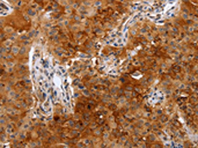 The image on the left is immunohistochemistry of paraffin-embedded Human lung cancer tissue using the antibody Antibody) at dilution 1/50, on the right is treated with fusion protein. (Original magnification: ×200)Rabbit anti-Human PLAUR Polyclonal Antibody
