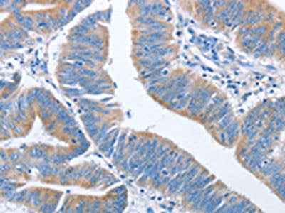 The image on the left is immunohistochemistry of paraffin-embedded Human colon cancer tissue using NCAPD2 Antibody(NCAPD2 Antibody) at dilution 1/40, on the right is treated with fusion protein. (Original magnification: ×200)Rabbit anti-Human NCAPD2 Polyclonal Antibody