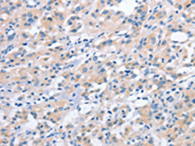 The image on the left is immunohistochemistry of paraffin-embedded Human thyroid cancer tissue using the antibody Antibody) at dilution 1/40, on the right is treated with fusion protein. (Original magnification: ×200)Rabbit anti-Human NCAPD2 Polyclonal Antibody