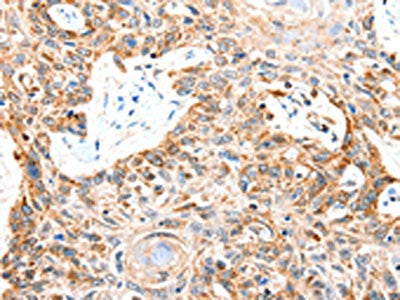 The image on the left is immunohistochemistry of paraffin-embedded Human esophagus cancer tissue using SLC2A1 Antibody(SLC2A1 Antibody) at dilution 1/50, on the right is treated with synthetic peptide. (Original magnification: ×200)Rabbit anti-Human SLC2A1 Polyclonal Antibody