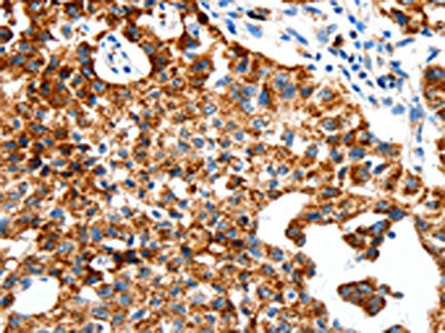 The image on the left is immunohistochemistry of paraffin-embedded Human lung cancer tissue using the antibody Antibody) at dilution 1/50, on the right is treated with synthetic peptide. (Original magnification: ×200)Rabbit anti-Human SLC2A1 Polyclonal Antibody