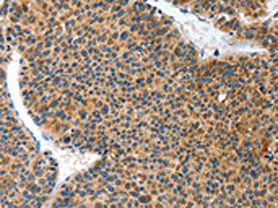 The image on the left is immunohistochemistry of paraffin-embedded Human liver cancer tissue using ANKRD54 Antibody(ANKRD54 Antibody) at dilution 1/50, on the right is treated with fusion protein. (Original magnification: ×200)Rabbit anti-Human ANKRD54 Polyclonal Antibody