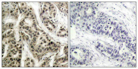 Immunohistochemical analysis of paraffin- embedded human breast carcinoma tissue using NF-kappa;B p105/p50 (phospho-Ser337) antibody.Rabbit anti-Human NFKB1 Polyclonal Antibody
