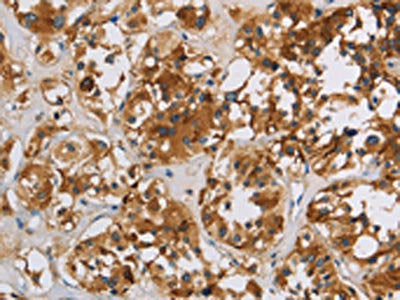 The image on the left is immunohistochemistry of paraffin-embedded Human thyroid cancer tissue using IGF2R Antibody(IGF2R Antibody) at dilution 1/50, on the right is treated with synthetic peptide. (Original magnification: ×200)Rabbit anti-Human IGF2R Polyclonal Antibody