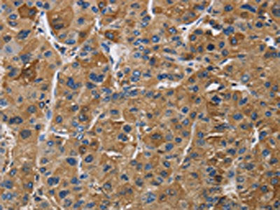 The image on the left is immunohistochemistry of paraffin-embedded Human liver cancer tissue using the antibody Antibody) at dilution 1/50, on the right is treated with synthetic peptide. (Original magnification: ×200)Rabbit anti-Human IGF2R Polyclonal Antibody