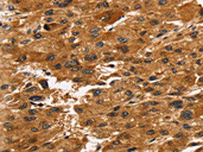 The image on the left is immunohistochemistry of paraffin-embedded Human liver cancer tissue using the antibody Antibody) at dilution 1/30, on the right is treated with synthetic peptide. (Original magnification: ×200)Rabbit anti-Human TACC2 Polyclonal Antibody