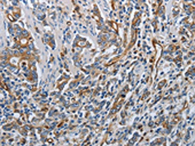 The image on the left is immunohistochemistry of paraffin-embedded Human gastric cancer tissue using SOCS1 Antibody(SOCS1 Antibody) at dilution 1/70, on the right is treated with synthetic peptide. (Original magnification: ×200)Rabbit anti-Human SOCS1 Polyclonal Antibody