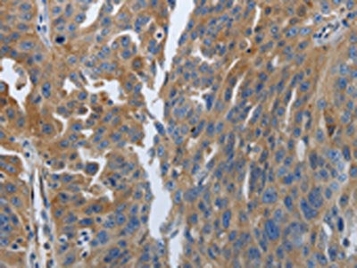 The image on the left is immunohistochemistry of paraffin-embedded Human ovarian cancer tissue using the antibody Antibody) at dilution 1/70, on the right is treated with synthetic peptide. (Original magnification: ×200)Rabbit anti-Human SOCS1 Polyclonal Antibody
