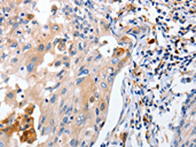 The image on the left is immunohistochemistry of paraffin-embedded Human cervical cancer tissue using IL18 Antibody(IL18 Antibody) at dilution 1/100, on the right is treated with fusion protein. (Original magnification: ×200)Rabbit anti-Human IL18 Polyclonal Antibody