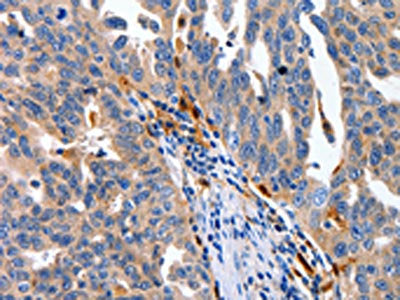 The image on the left is immunohistochemistry of paraffin-embedded Human ovarian cancer tissue using the antibody Antibody) at dilution 1/100, on the right is treated with fusion protein. (Original magnification: ×200)