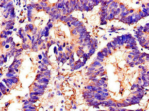 Immunohistochemistry of paraffin-embedded human colon cancer using SWI5 Antibody at dilution of 1:100