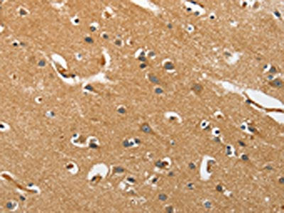 The image on the left is immunohistochemistry of paraffin-embedded Human brain tissue using EPHB3 Antibody(EPHB3 Antibody) at dilution 1/40, on the right is treated with synthetic peptide. (Original magnification: ×200)Rabbit anti-Human EPHB3 Polyclonal Antibody