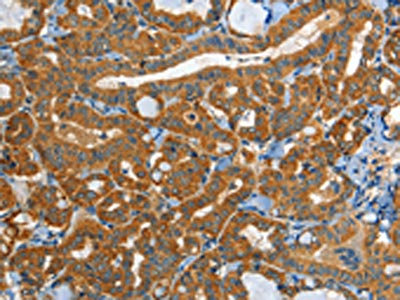 The image on the left is immunohistochemistry of paraffin-embedded Human thyroid cancer tissue using the antibody Antibody) at dilution 1/40, on the right is treated with synthetic peptide. (Original magnification: ×200)Rabbit anti-Human EPHB3 Polyclonal Antibody