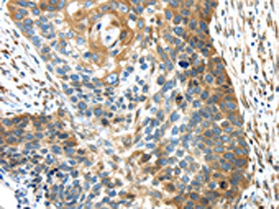 The image on the left is immunohistochemistry of paraffin-embedded Human esophagus cancer tissue using TMED4 Antibody(TMED4 Antibody) at dilution 1/45, on the right is treated with fusion protein. (Original magnification: ×200)Rabbit anti-Human TMED4 Polyclonal Antibody