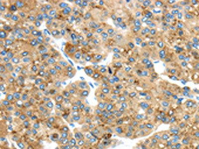 The image on the left is immunohistochemistry of paraffin-embedded Human liver cancer tissue using the antibody Antibody) at dilution 1/45, on the right is treated with fusion protein. (Original magnification: ×200)Rabbit anti-Human TMED4 Polyclonal Antibody