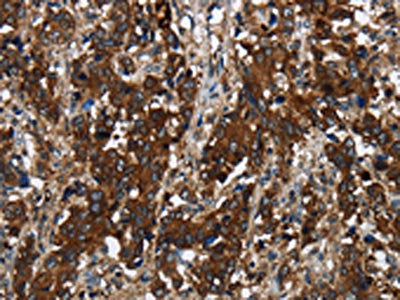 The image on the left is immunohistochemistry of paraffin-embedded Human liver cancer tissue using the antibody Antibody) at dilution 1/60, on the right is treated with fusion protein. (Original magnification: ×200)Rabbit anti-Human GLIPR1 Polyclonal Antibody