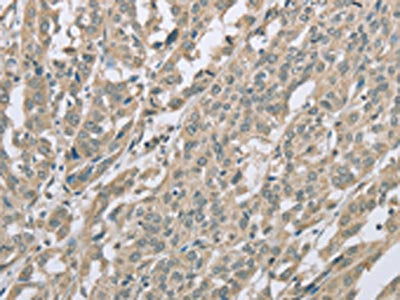 The image on the left is immunohistochemistry of paraffin-embedded Human ovarian cancer tissue using EDA2R Antibody(EDA2R Antibody) at dilution 1/60, on the right is treated with fusion protein. (Original magnification: ×200)Rabbit anti-Human EDA2R Polyclonal Antibody