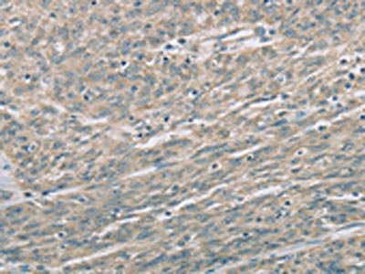 The image on the left is immunohistochemistry of paraffin-embedded Human esophagus cancer tissue using the antibody Antibody) at dilution 1/60, on the right is treated with fusion protein. (Original magnification: ×200)Rabbit anti-Human EDA2R Polyclonal Antibody