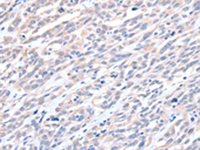 The image on the left is immunohistochemistry of paraffin-embedded Human esophagus cancer tissue using ACTL8 Antibody(ACTL8 Antibody) at dilution 1/15, on the right is treated with fusion protein. (Original magnification: ×200)