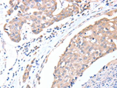 The image on the left is immunohistochemistry of paraffin-embedded Human breast cancer tissue using the antibody Antibody) at dilution 1/15, on the right is treated with fusion protein. (Original magnification: ×200)