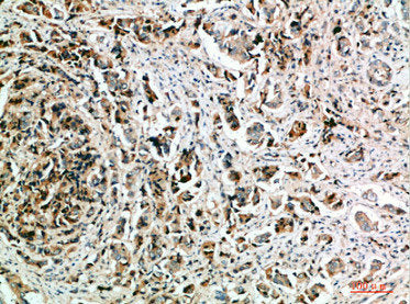 Immunohistochemical analysis of paraffin-embedded human-breast-cancer, antibody was diluted at 1:200Rabbit anti-Human NANOS1 Polyclonal Antibody