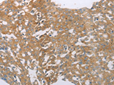 The image on the left is immunohistochemistry of paraffin-embedded Human breast cancer tissue using PDK4 Antibody(PDK4 Antibody) at dilution 1/50, on the right is treated with synthetic peptide. (Original magnification: ×200)Rabbit anti-Human PDK4 Polyclonal Antibody