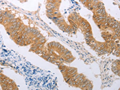 The image on the left is immunohistochemistry of paraffin-embedded Human colon cancer tissue using the antibody Antibody) at dilution 1/50, on the right is treated with synthetic peptide. (Original magnification: ×200)Rabbit anti-Human PDK4 Polyclonal Antibody