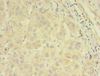 Immunohistochemistry of paraffin-embedded human liver cancer using the antibody at dilution of 1:100