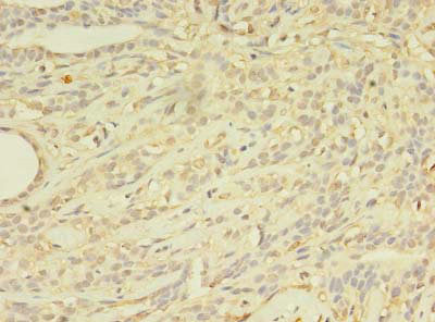 Immunohistochemistry of paraffin-embedded human breast cancer using ABCB5 Antibody at dilution of 1:100